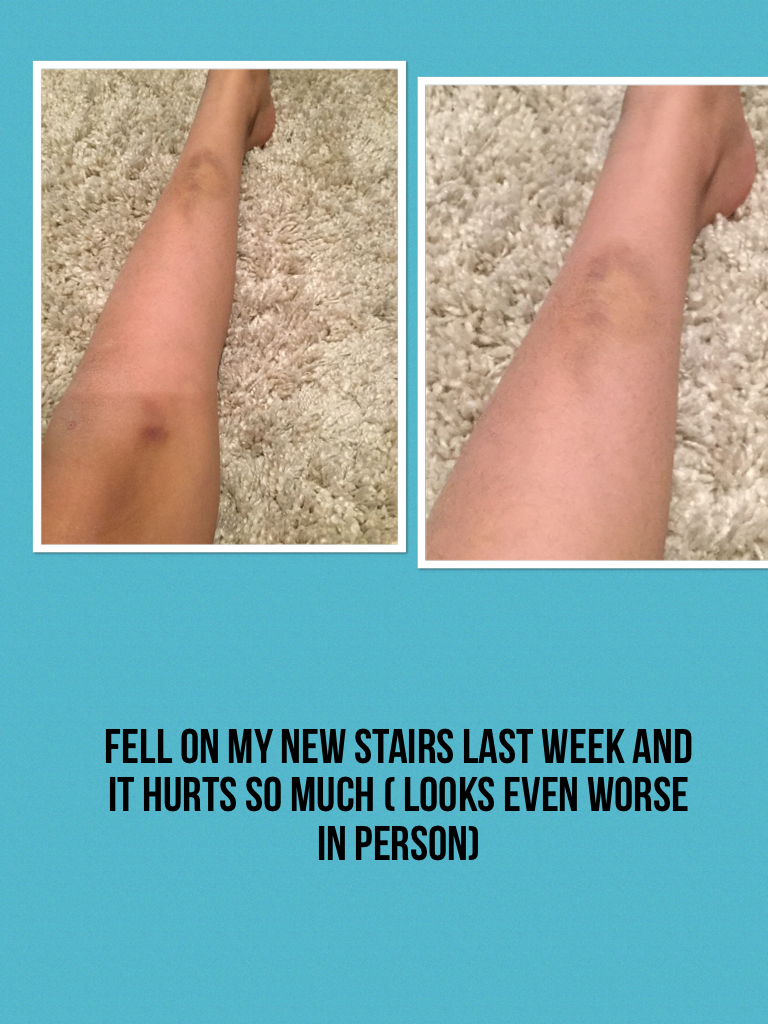 Fell on my new stairs last week and it hurts so much ( looks even worse in person)