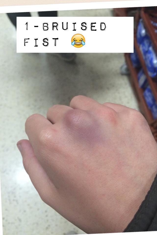 1-bruised fist 😂