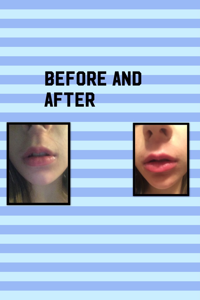 Before and after how to get big lips 👄 