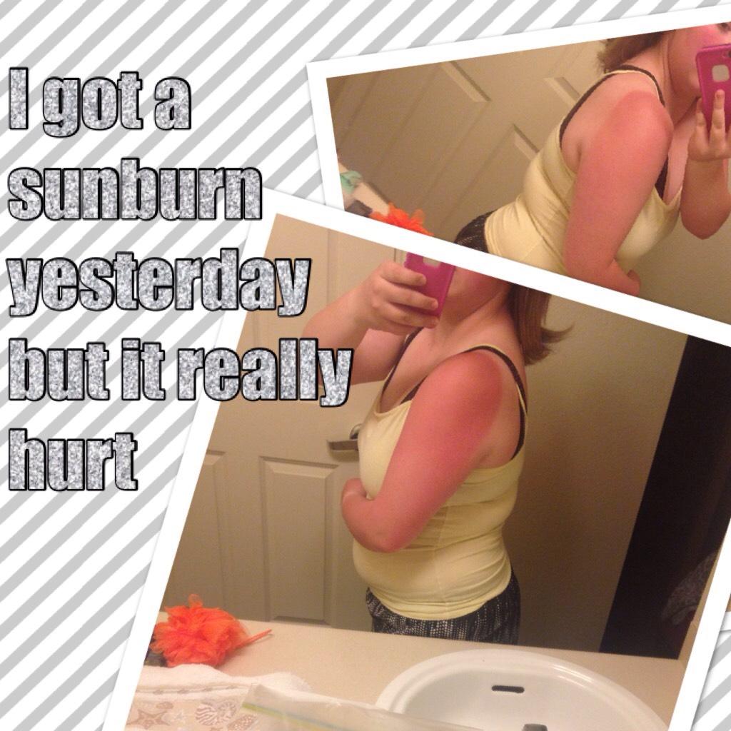 I got a sunburn yesterday but it really hurt 