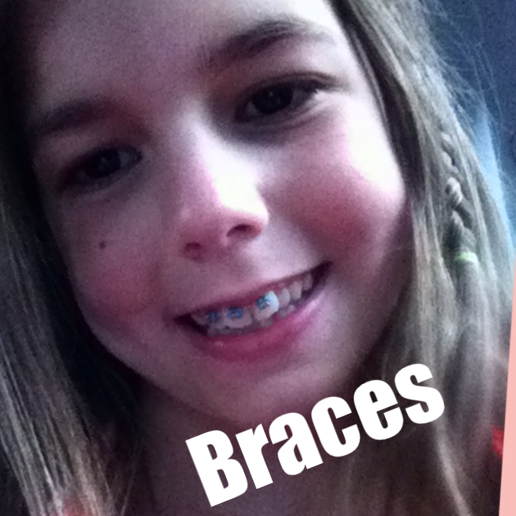 Blue braces I am so excited.
# Braces 