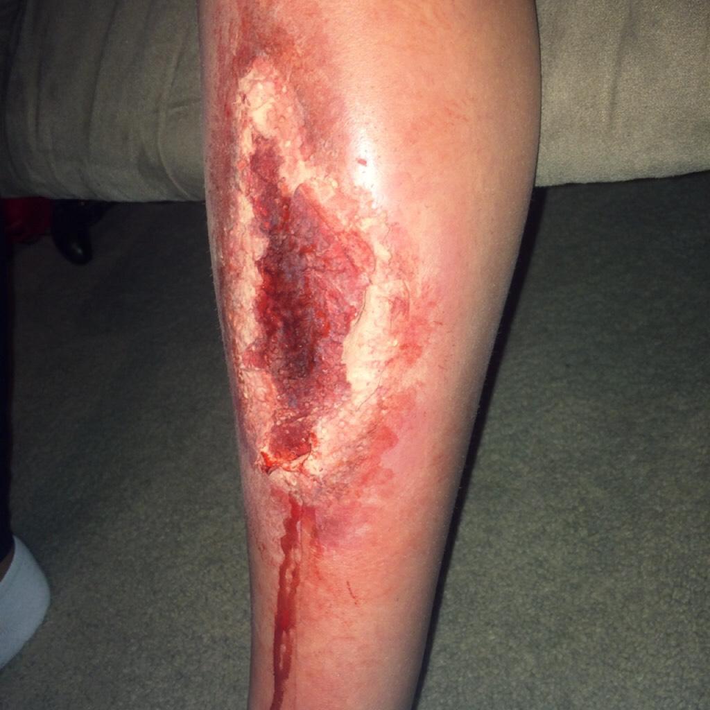 I tried doing sfx makeup for the first time today and I'm kinda proud of this one (on my sisters leg) I don't have any proper tools/makeup like scar wax, etc so it was kinda hard :/ but it's alright ig