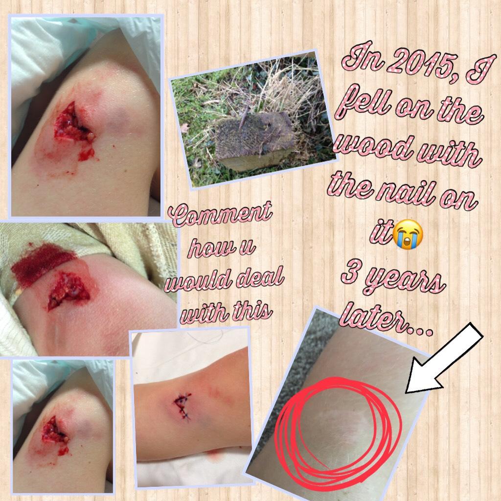 In 2015, I fell on the wood with the nail on it😭
3 years later...