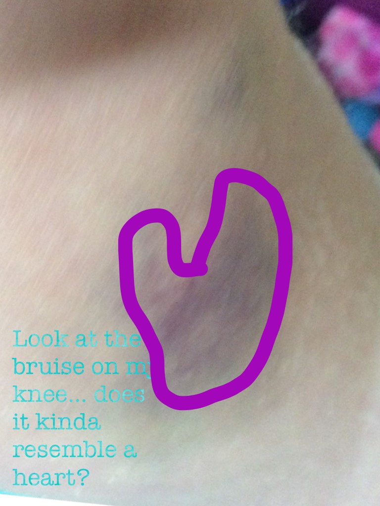 Look at the bruise on my knee... does it kinda resemble a heart?