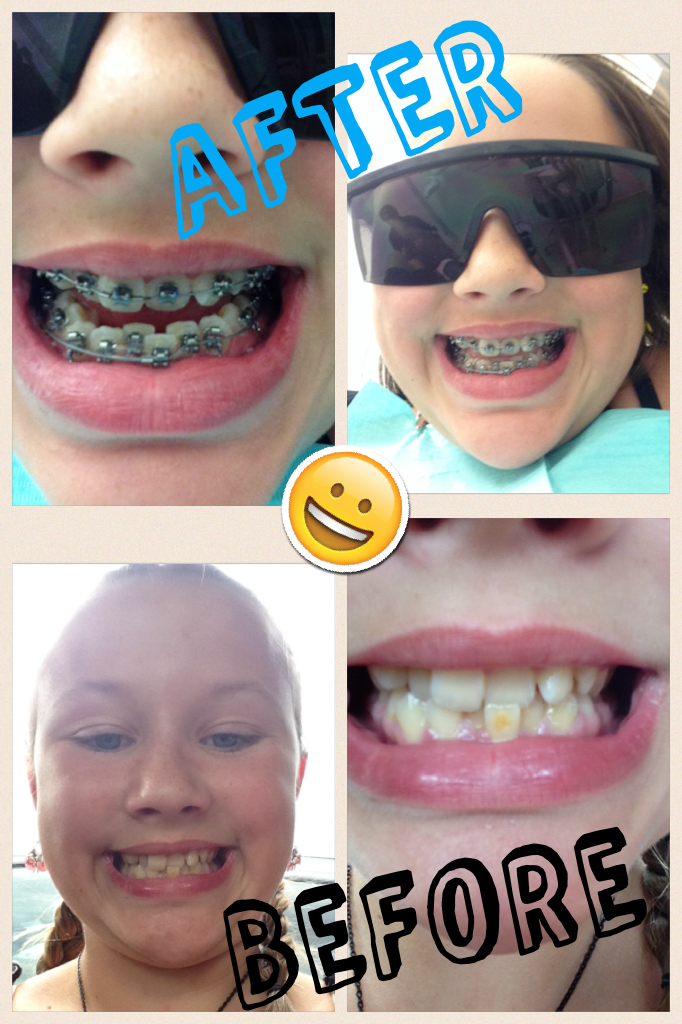 Before and after my braces! I just got them yesterday